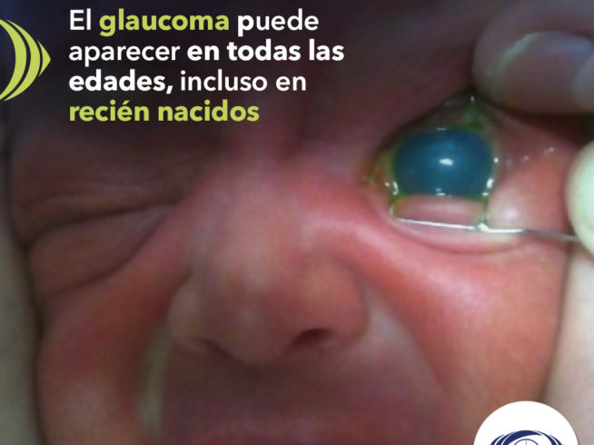 El glaucoma puede aparecer en todas las edades, incluso en recién nacidos