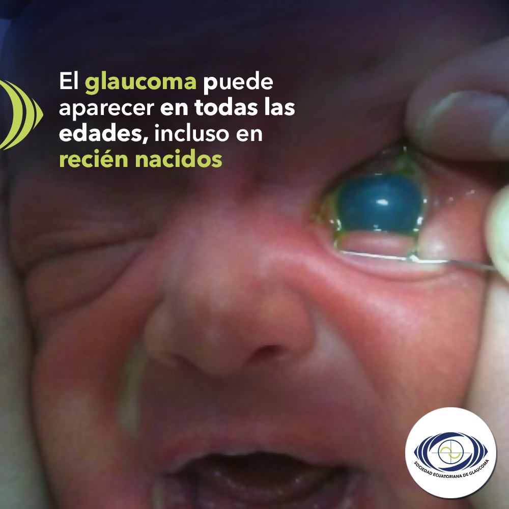 El glaucoma puede aparecer en todas las edades, incluso en recién nacidos