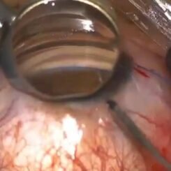 Taller Cirugía Angular en Glaucoma | Sociedad Ecuatoriana de Glaucoma